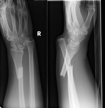 Complex Fracture Management | Dr. Saurabh Khare