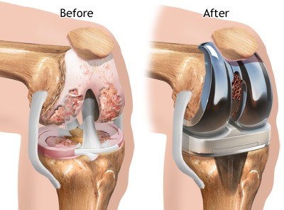 Best Knee Replacement Doctor in Raipur | Dr. Saurabh Khare