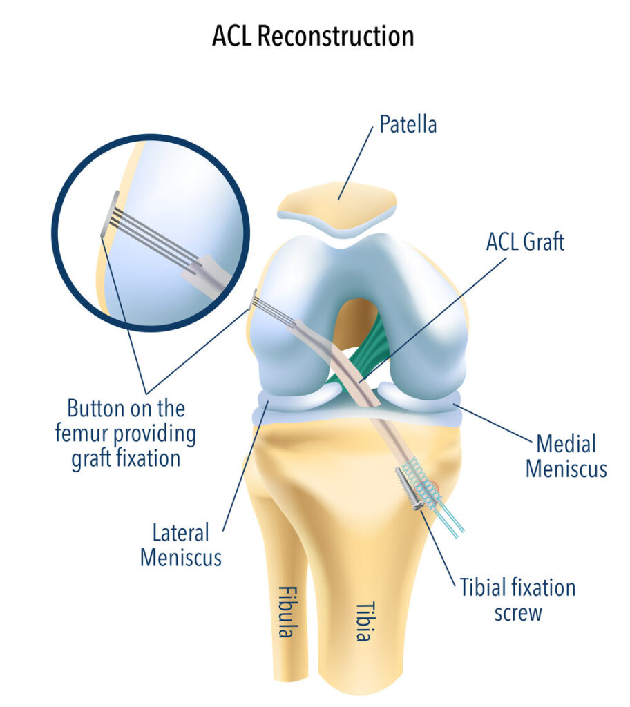 Arthroscopic ACL Reconstruction Process