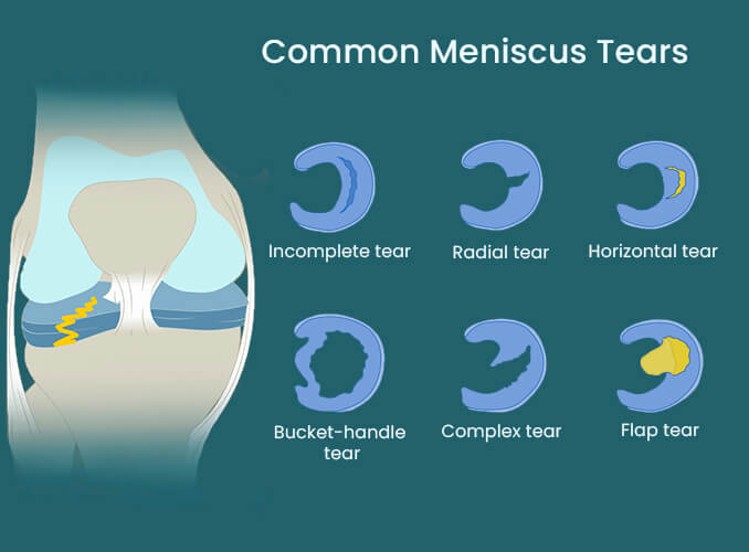 Anatomy-of-Meniscus-Tear