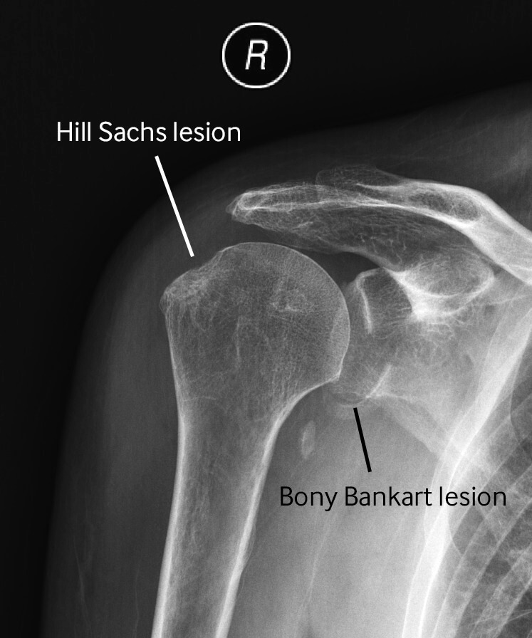 Shoulder dislocation/Bankart leision | Dr. Saurabh Khare