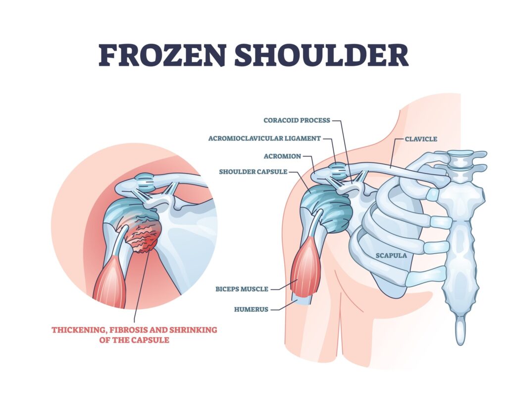 Frozen Shoulder Treatment in Raipur