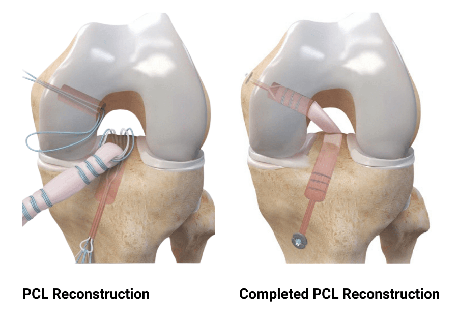 knee pcl injury doctor