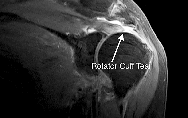 Best Knee MPFL Injury treatment in Raipur