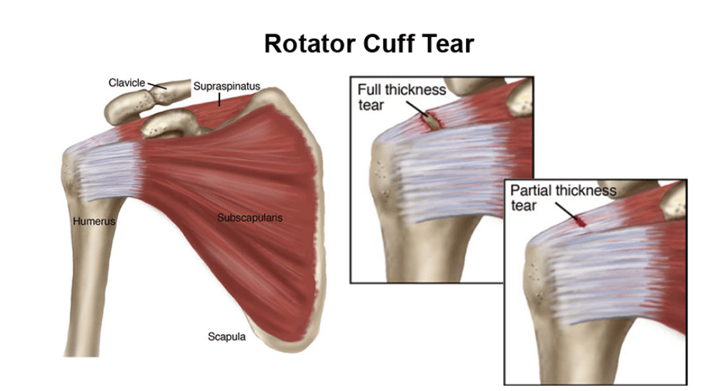 Shoulder Arthroscopy Surgeon in Raipur | Dr. Saurabh Khare