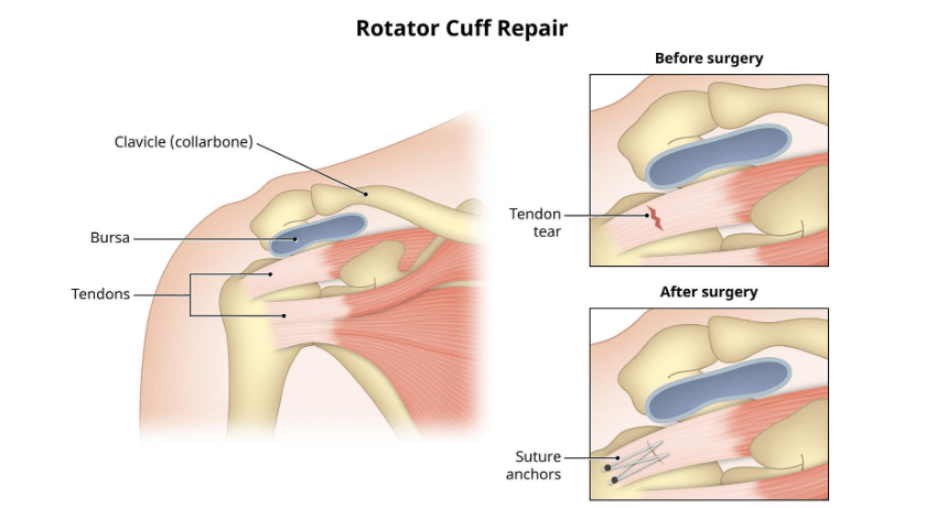 Rotator cuff injury - Symptoms and causes | Dr. Saurabh Khare