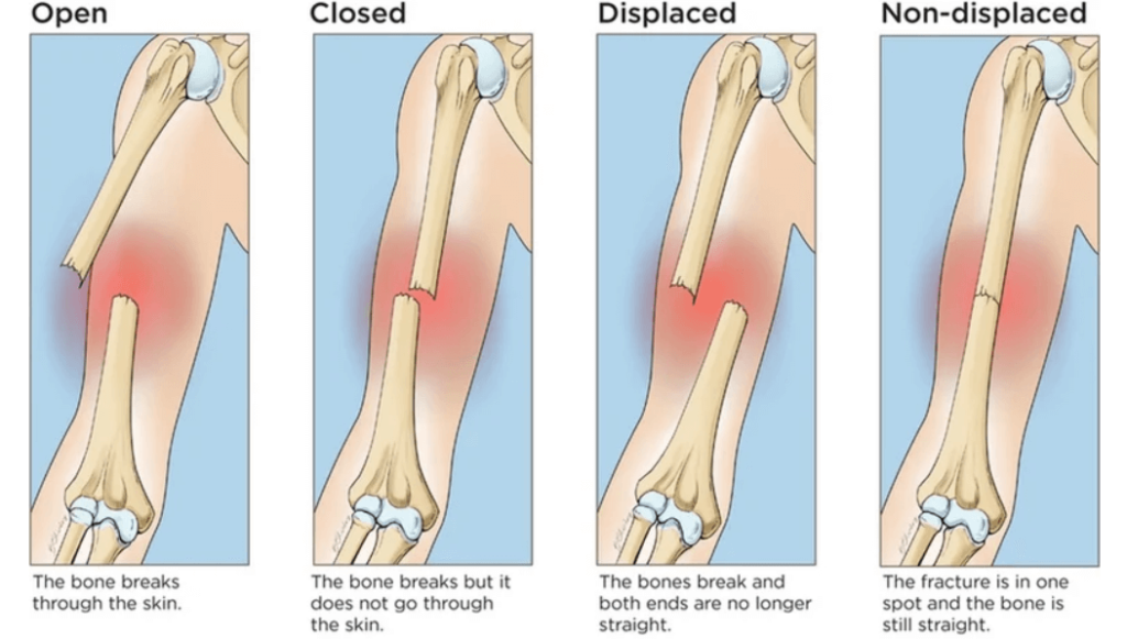 Upper Limb Fracture Treatment in Raipur