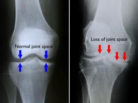 Total Knee Replacement