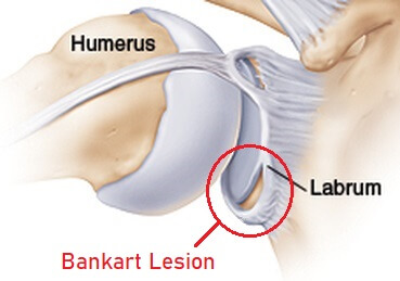 Shoulder Dislocation Repair in Raipur