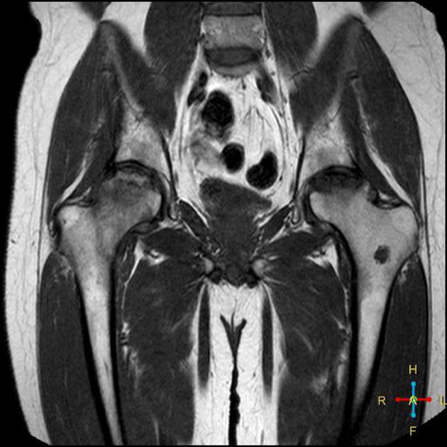 Best Hip Replacement Doctor in Raipur