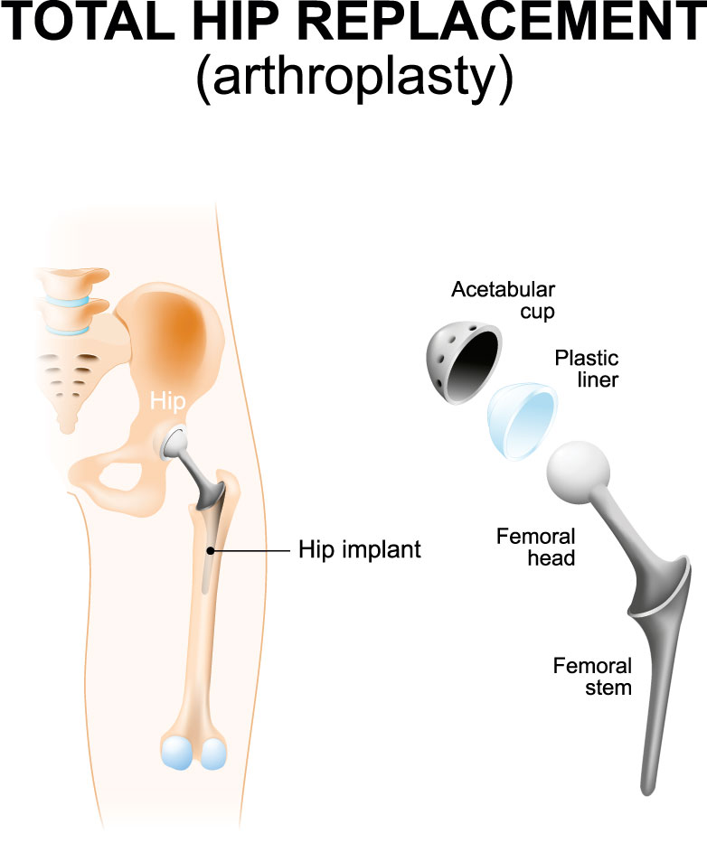 Hip Replacement Doctor
