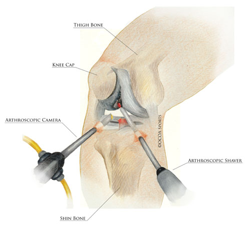 Arthroscopy as Treatment Option