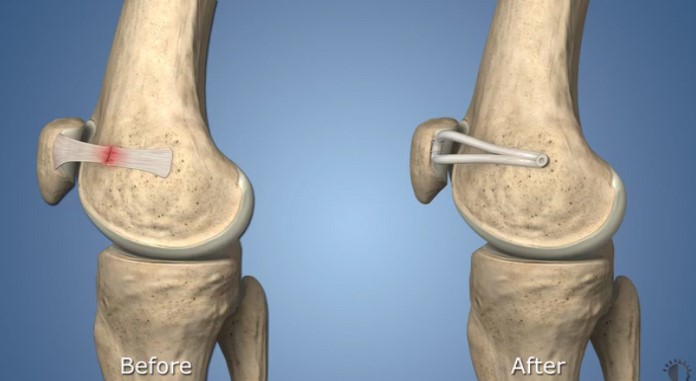 Best Knee MPFL Injury treatment in Raipur