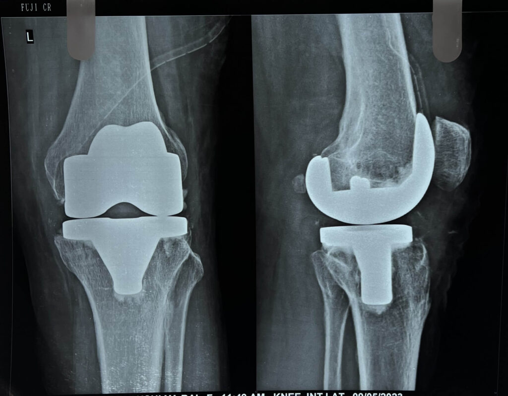 Total Knee Replacement