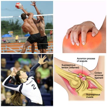 Shoulder Dislocation Repair in Raipur